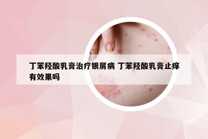 丁苯羟酸乳膏治疗银屑病 丁苯羟酸乳膏止痒有效果吗