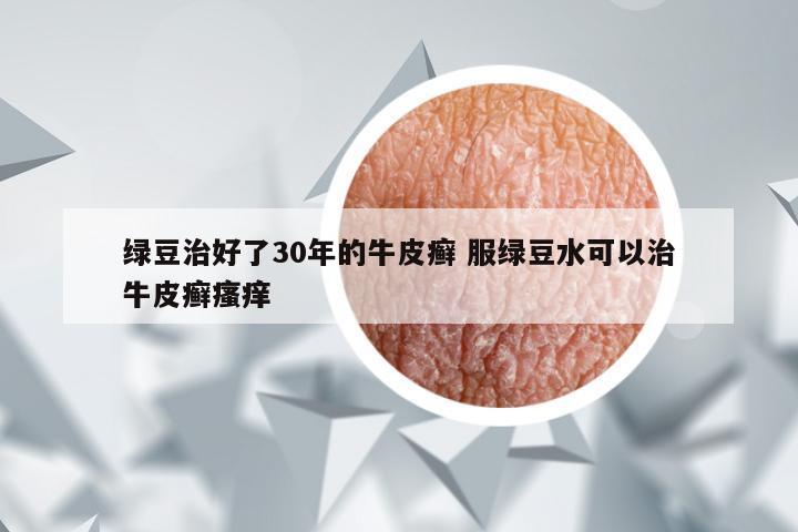 绿豆治好了30年的牛皮癣 服绿豆水可以治牛皮癣瘙痒
