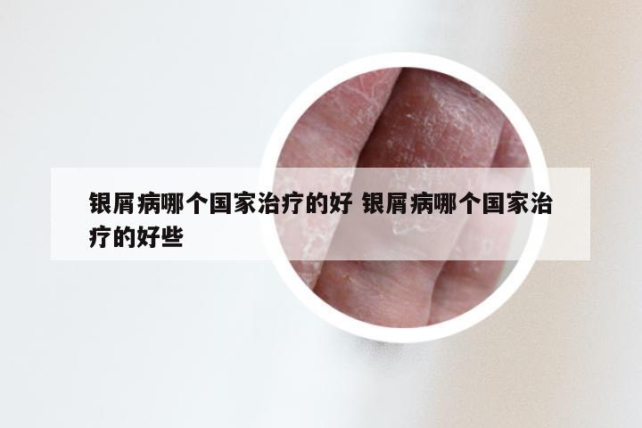 银屑病哪个国家治疗的好 银屑病哪个国家治疗的好些