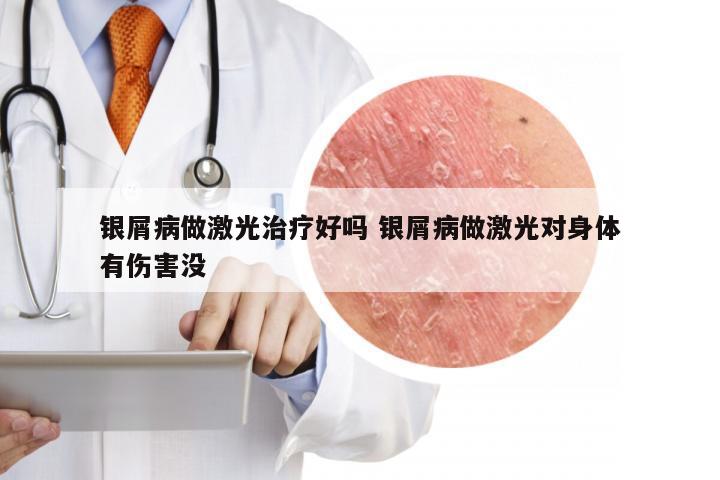 银屑病做激光治疗好吗 银屑病做激光对身体有伤害没