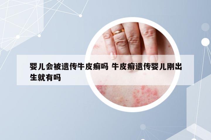 婴儿会被遗传牛皮癣吗 牛皮癣遗传婴儿刚出生就有吗