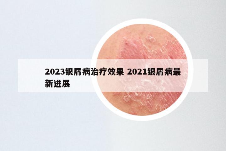 2023银屑病治疗效果 2021银屑病最新进展