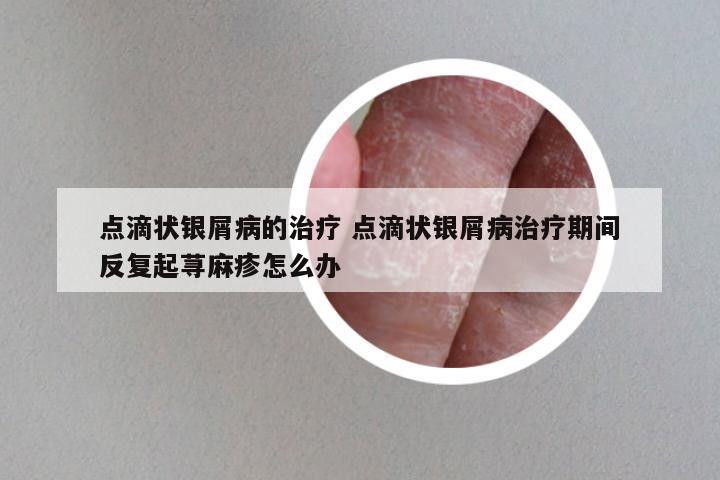点滴状银屑病的治疗 点滴状银屑病治疗期间反复起荨麻疹怎么办