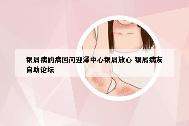银屑病的病因问迎泽中心银屑放心 银屑病友自助论坛