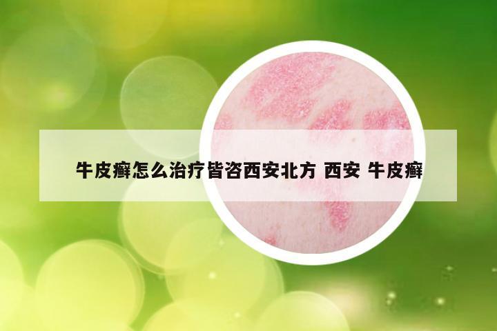牛皮癣怎么治疗皆咨西安北方 西安 牛皮癣