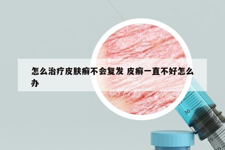 怎么治疗皮肤癣不会复发 皮癣一直不好怎么办
