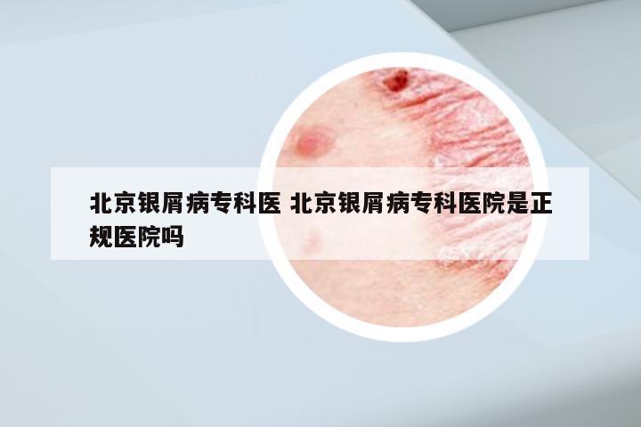 北京银屑病专科医 北京银屑病专科医院是正规医院吗