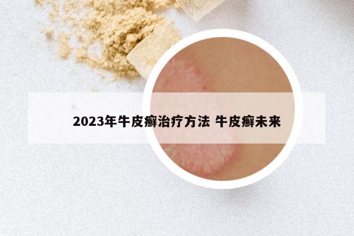 2023年牛皮癣治疗方法 牛皮癣未来