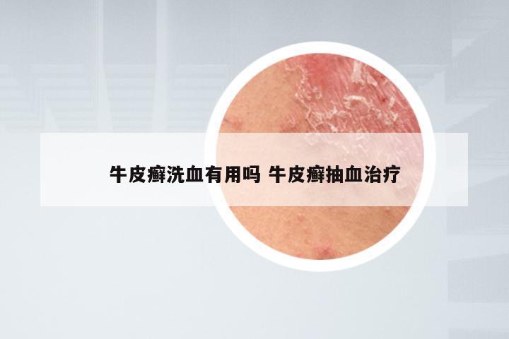 牛皮癣洗血有用吗 牛皮癣抽血治疗