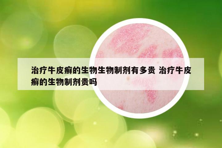 治疗牛皮癣的生物生物制剂有多贵 治疗牛皮癣的生物制剂贵吗