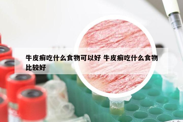 牛皮癣吃什么食物可以好 牛皮癣吃什么食物比较好