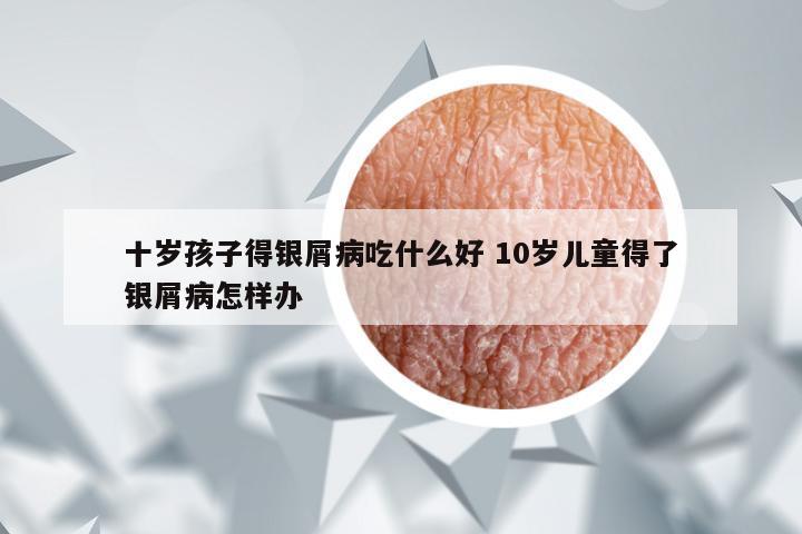 十岁孩子得银屑病吃什么好 10岁儿童得了银屑病怎样办