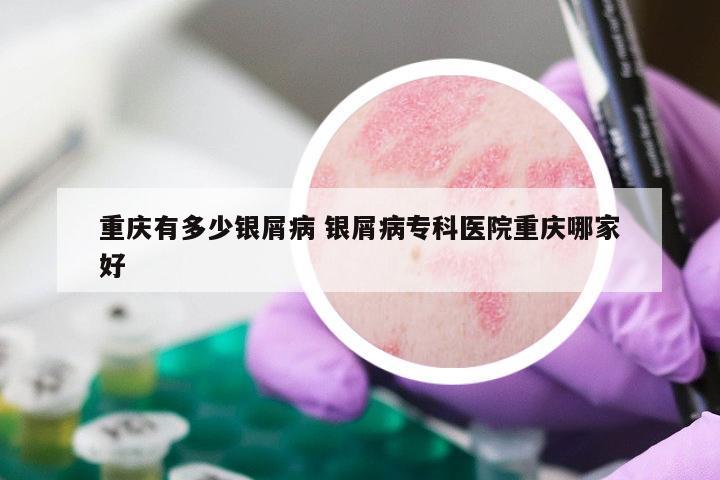 重庆有多少银屑病 银屑病专科医院重庆哪家好