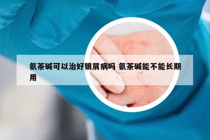 氨茶碱可以治好银屑病吗 氨茶碱能不能长期用