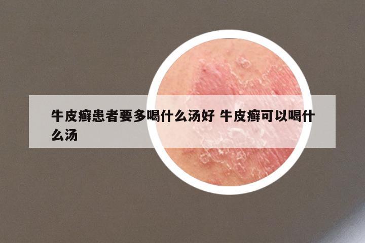 牛皮癣患者要多喝什么汤好 牛皮癣可以喝什么汤