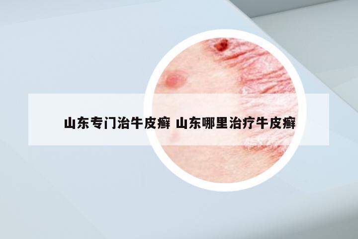 山东专门治牛皮癣 山东哪里治疗牛皮癣