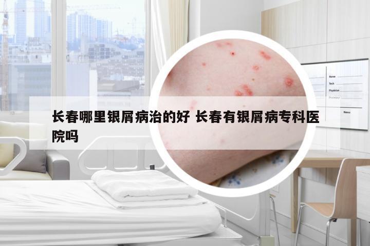 长春哪里银屑病治的好 长春有银屑病专科医院吗