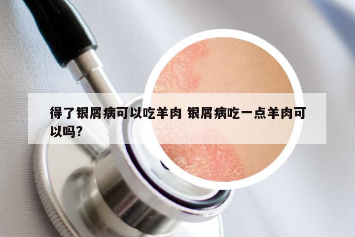 得了银屑病可以吃羊肉 银屑病吃一点羊肉可以吗?