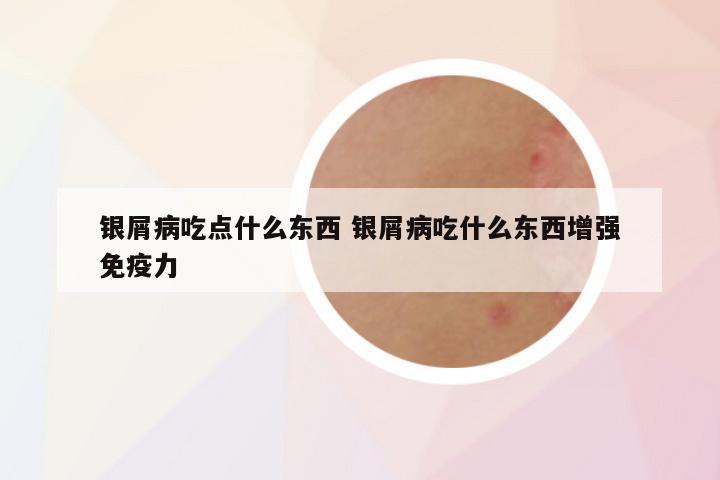 银屑病吃点什么东西 银屑病吃什么东西增强免疫力