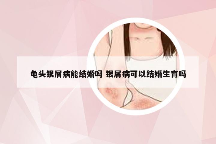 龟头银屑病能结婚吗 银屑病可以结婚生育吗