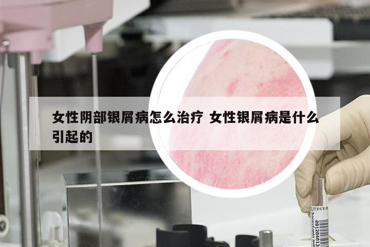 女性阴部银屑病怎么治疗 女性银屑病是什么引起的