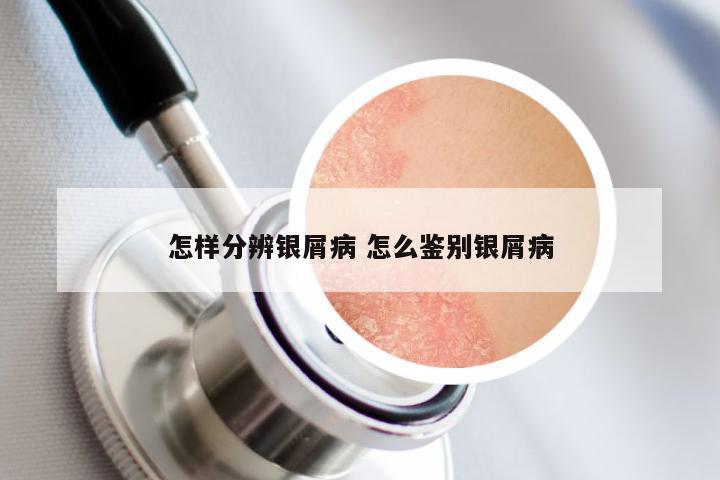 怎样分辨银屑病 怎么鉴别银屑病