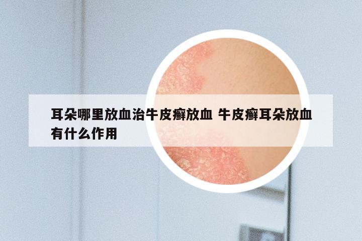 耳朵哪里放血治牛皮癣放血 牛皮癣耳朵放血有什么作用