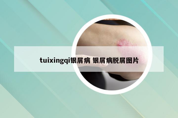 tuixingqi银屑病 银屑病脱屑图片