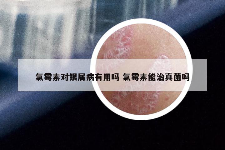 氯霉素对银屑病有用吗 氯霉素能治真菌吗
