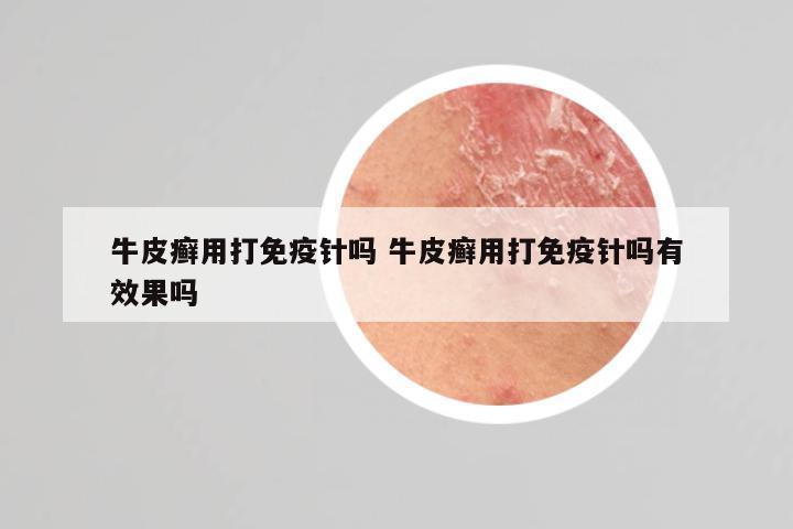 牛皮癣用打免疫针吗 牛皮癣用打免疫针吗有效果吗