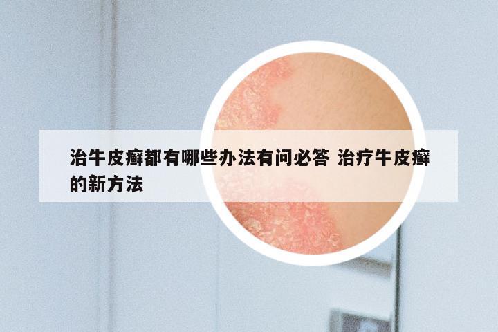 治牛皮癣都有哪些办法有问必答 治疗牛皮癣的新方法