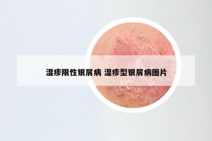 湿疹限性银屑病 湿疹型银屑病图片