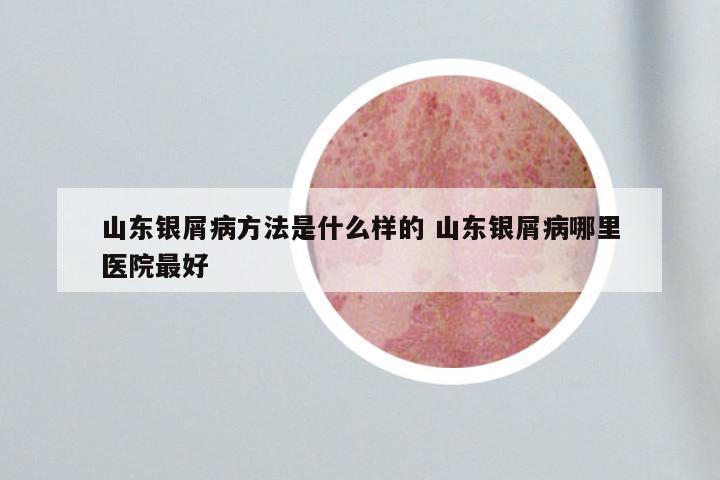 山东银屑病方法是什么样的 山东银屑病哪里医院最好