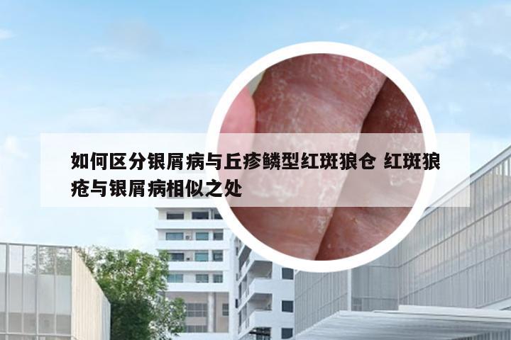 如何区分银屑病与丘疹鳞型红斑狼仓 红斑狼疮与银屑病相似之处