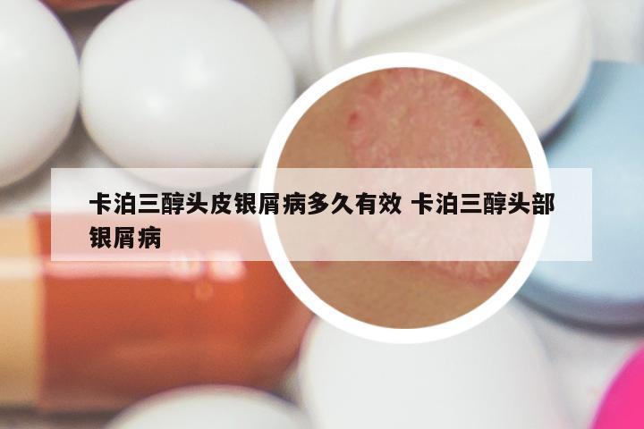 卡泊三醇头皮银屑病多久有效 卡泊三醇头部银屑病