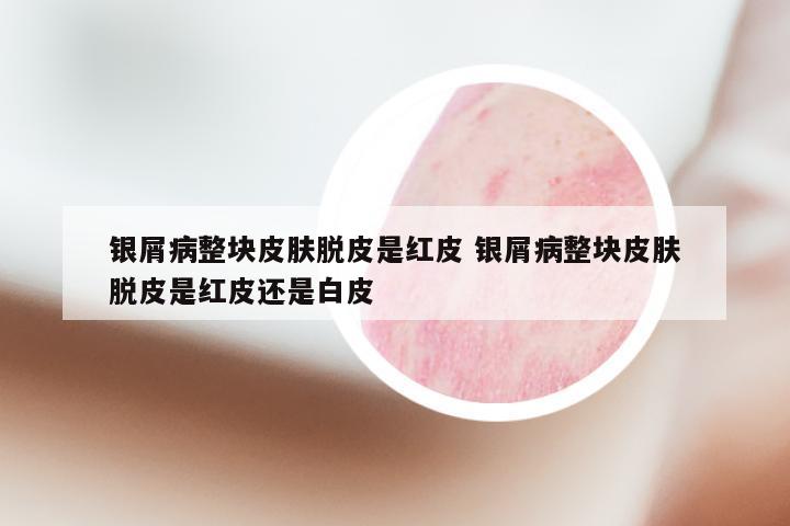 银屑病整块皮肤脱皮是红皮 银屑病整块皮肤脱皮是红皮还是白皮