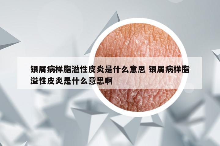 银屑病样脂溢性皮炎是什么意思 银屑病样脂溢性皮炎是什么意思啊
