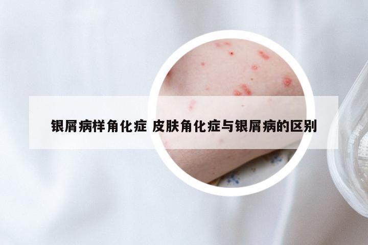 银屑病样角化症 皮肤角化症与银屑病的区别
