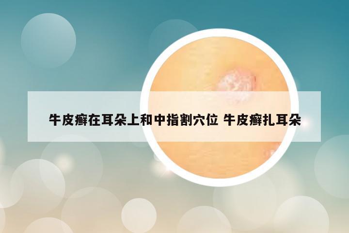 牛皮癣在耳朵上和中指割穴位 牛皮癣扎耳朵