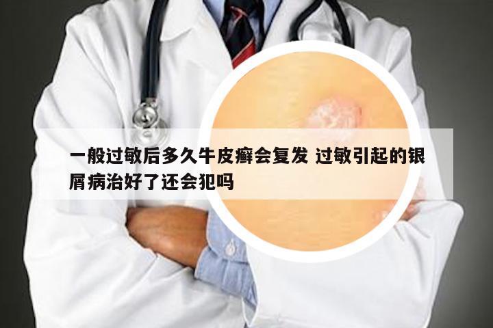 一般过敏后多久牛皮癣会复发 过敏引起的银屑病治好了还会犯吗