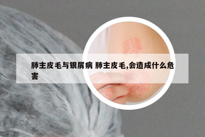肺主皮毛与银屑病 肺主皮毛,会造成什么危害
