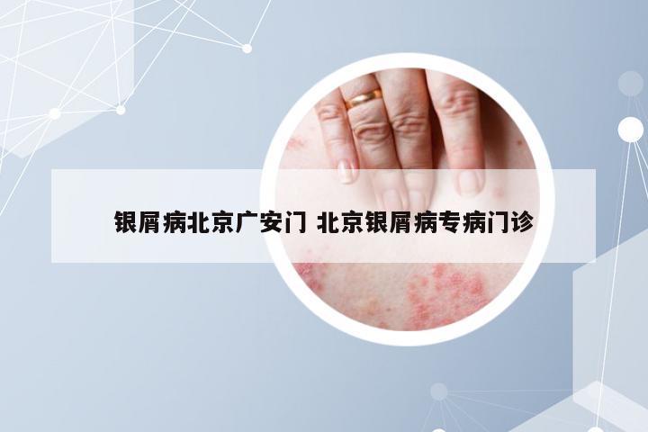 银屑病北京广安门 北京银屑病专病门诊