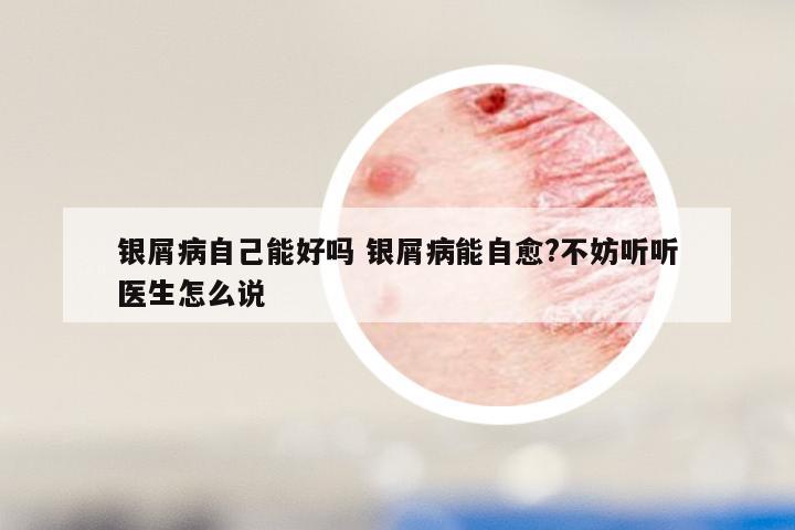银屑病自己能好吗 银屑病能自愈?不妨听听医生怎么说
