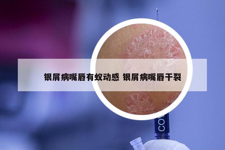 银屑病嘴唇有蚁动感 银屑病嘴唇干裂
