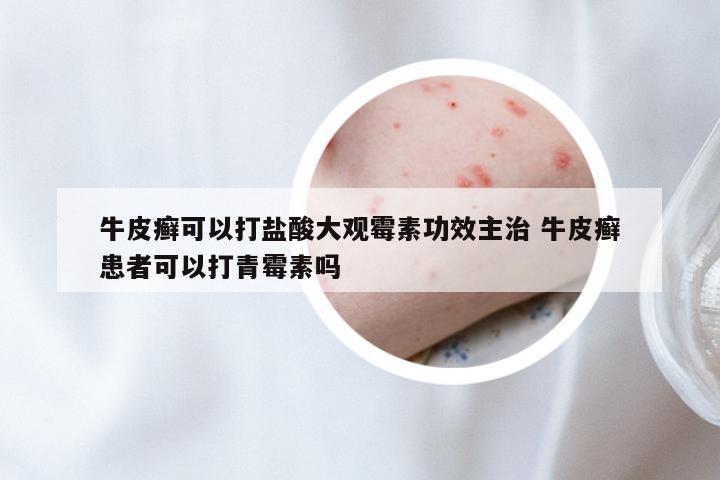 牛皮癣可以打盐酸大观霉素功效主治 牛皮癣患者可以打青霉素吗