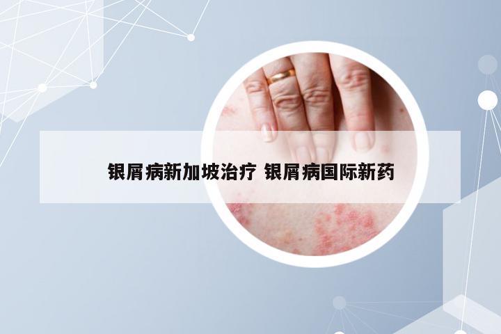 银屑病新加坡治疗 银屑病国际新药