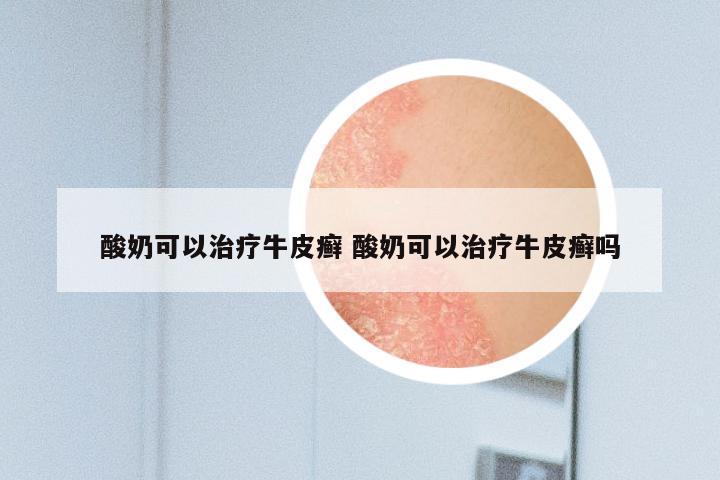 酸奶可以治疗牛皮癣 酸奶可以治疗牛皮癣吗