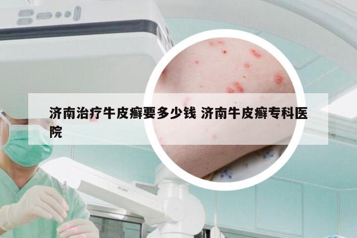 济南治疗牛皮癣要多少钱 济南牛皮癣专科医院
