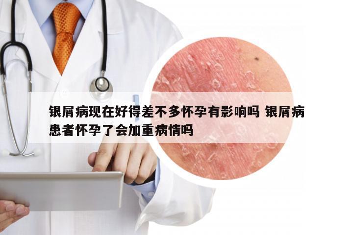 银屑病现在好得差不多怀孕有影响吗 银屑病患者怀孕了会加重病情吗