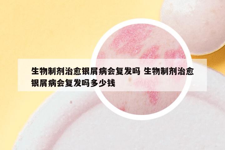 生物制剂治愈银屑病会复发吗 生物制剂治愈银屑病会复发吗多少钱